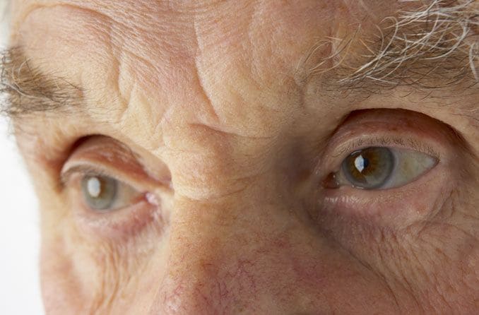 LASIK & presbiopia: Correção com PresbyLASIK