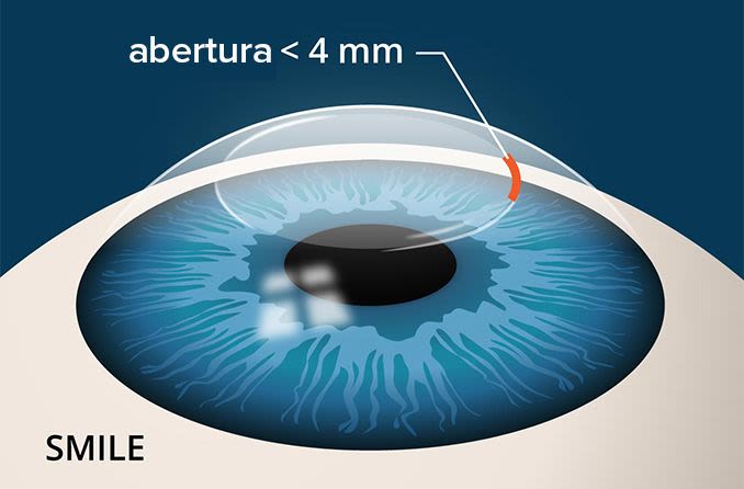 Cirurgia ocular SMILE: o que a difere da LASIK?