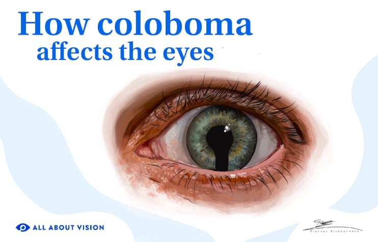 Coloboma