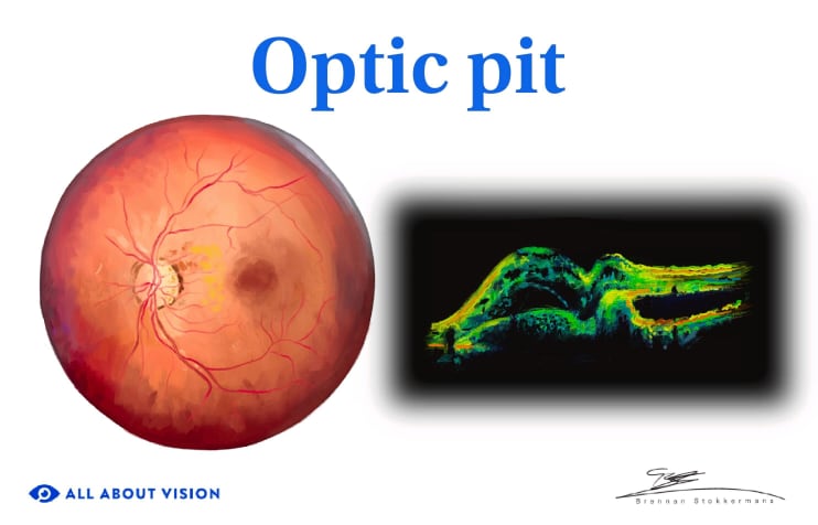 Optic Pit