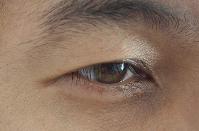 眼瞼下垂症：眼瞼下垂の原因と対応