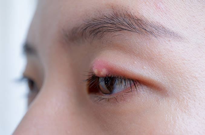 麦粒腫の解消法 - 麦粒腫の処置と治療法