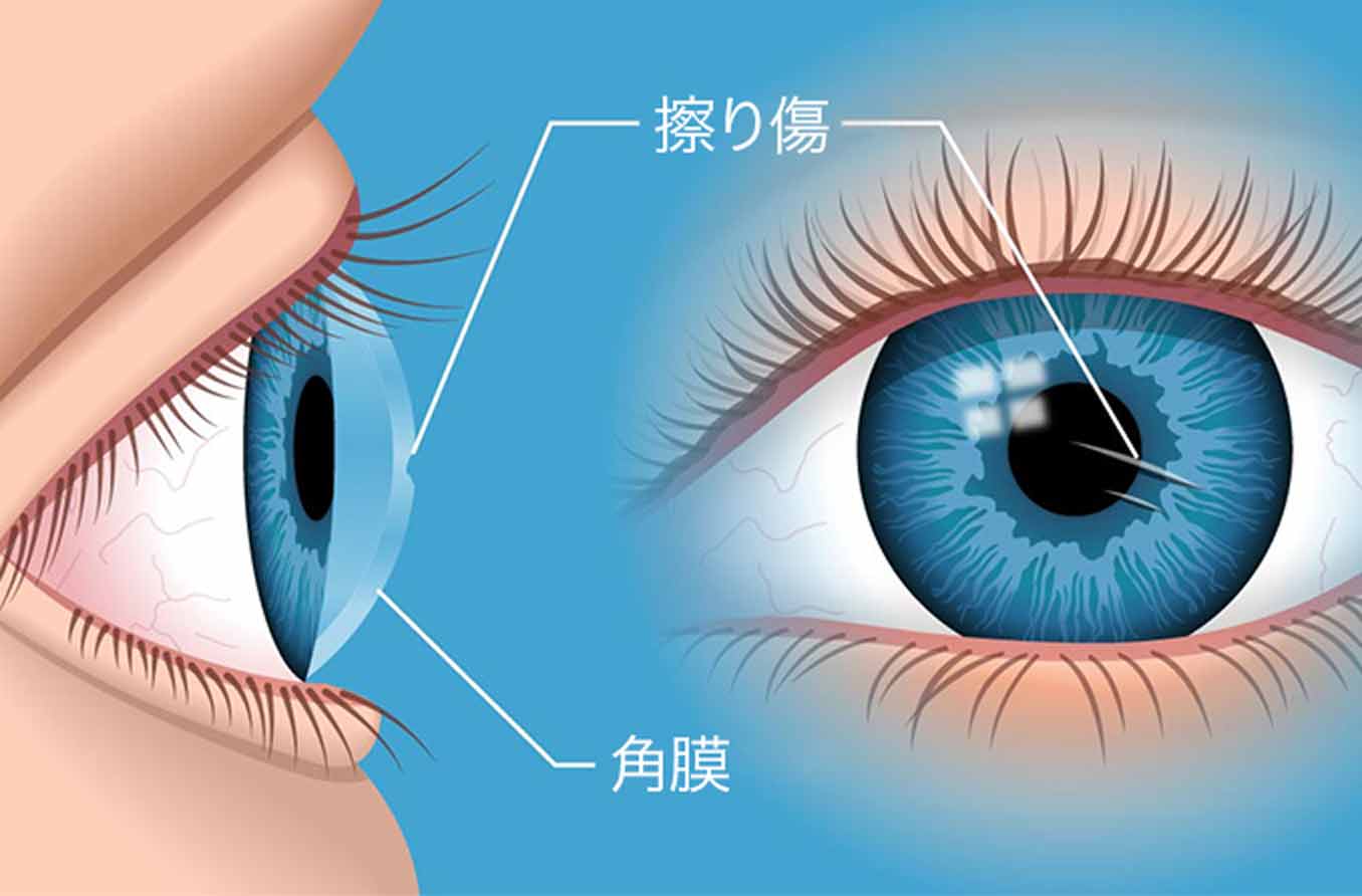 角膜剥離：角膜擦過傷の治療法