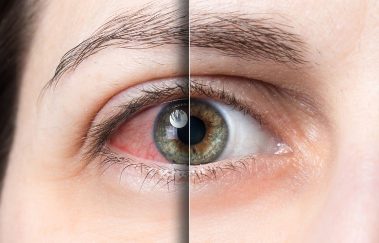 dry eye before and after close up