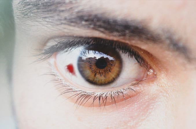 Sangue nell'occhio Sangue nell'occhio