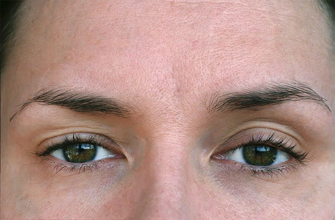 Donna con palpebre cadenti da ptosi Donna con palpebre cadenti da ptosi