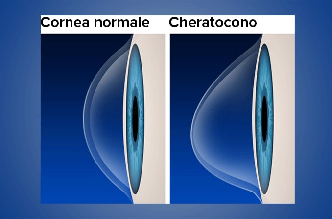 Cornea normale vs. cheratocono