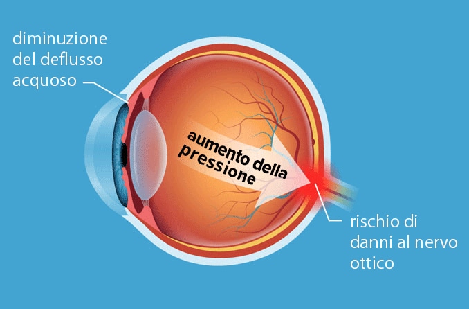 Illustrazione del diagramma della condizione di ipertensione oculare