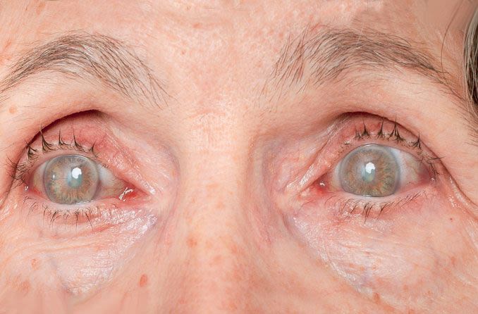 Diabetic eye problems: How diabetes affects the eyes