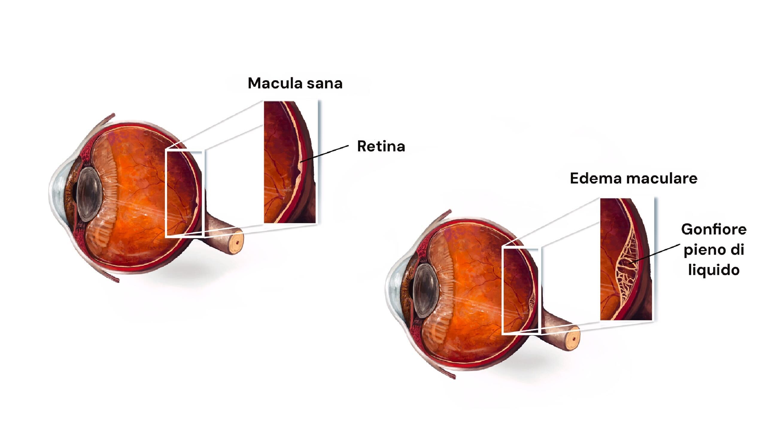 Edema Maculare