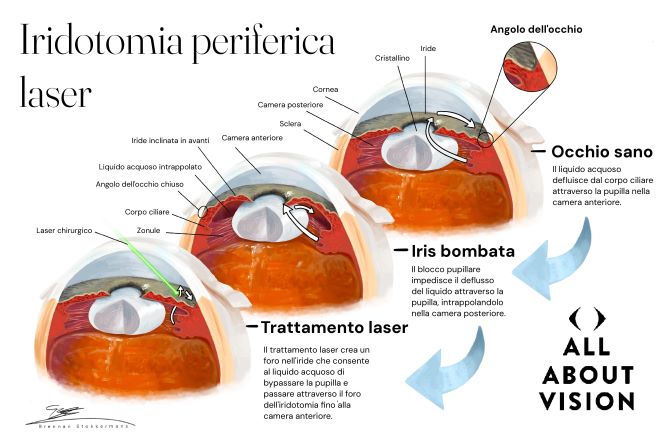 iride blu e cuore liquido testo Come viene trattato il glaucoma?