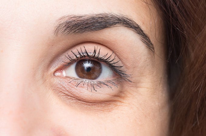 वर्त्मपात (Ptosis): पलकों के लटकने के कारण और उपचार