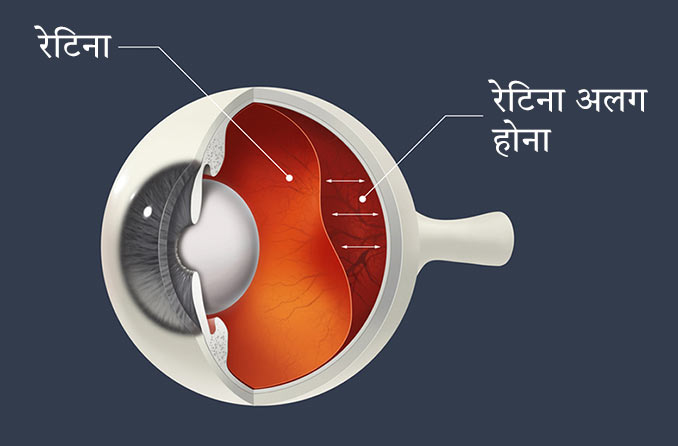 अलग हुआ रेटिना: कारण, लक्षण और उपचार