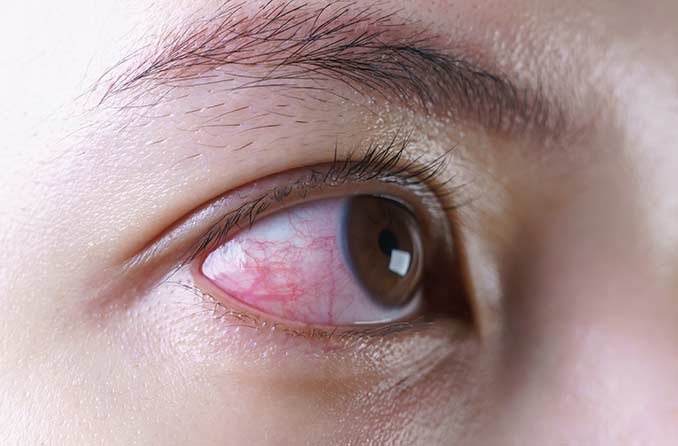 การติดเชื้อที่ตา: ชนิด อาการ การรักษา