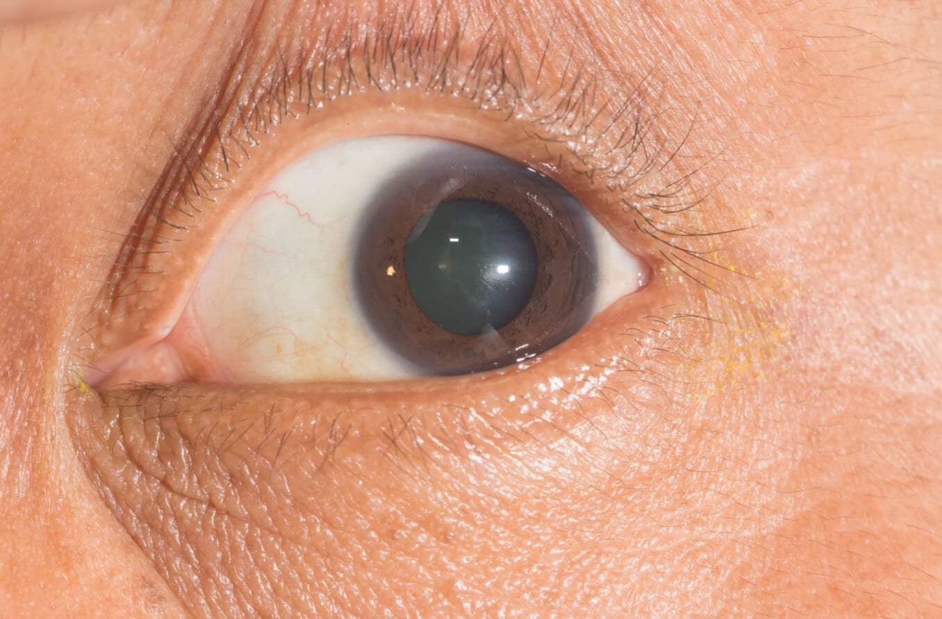 รูม่านตาขยาย: สาเหตุและการรักษา