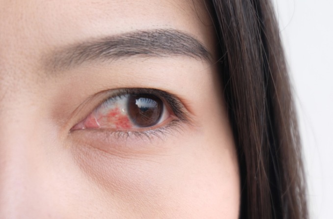 Mắt đỏ: Nguyên nhân và điều trị 