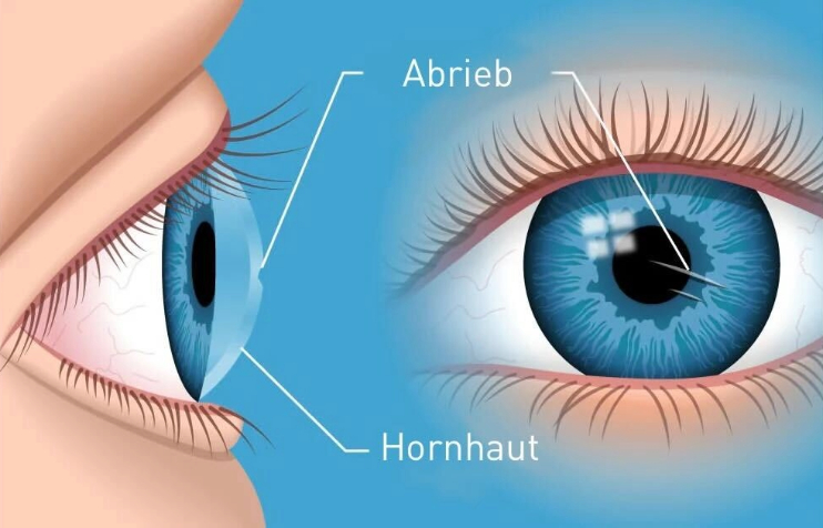 Kratzer im Auge: Wie man eine Hornhautabschürfung behandelt