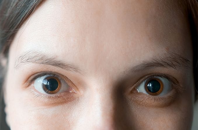 closeup of a woman's eyes after getting eye dilation exam