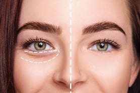 Tear trough before and after