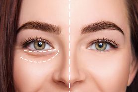 Tear trough filler Tear trough filler