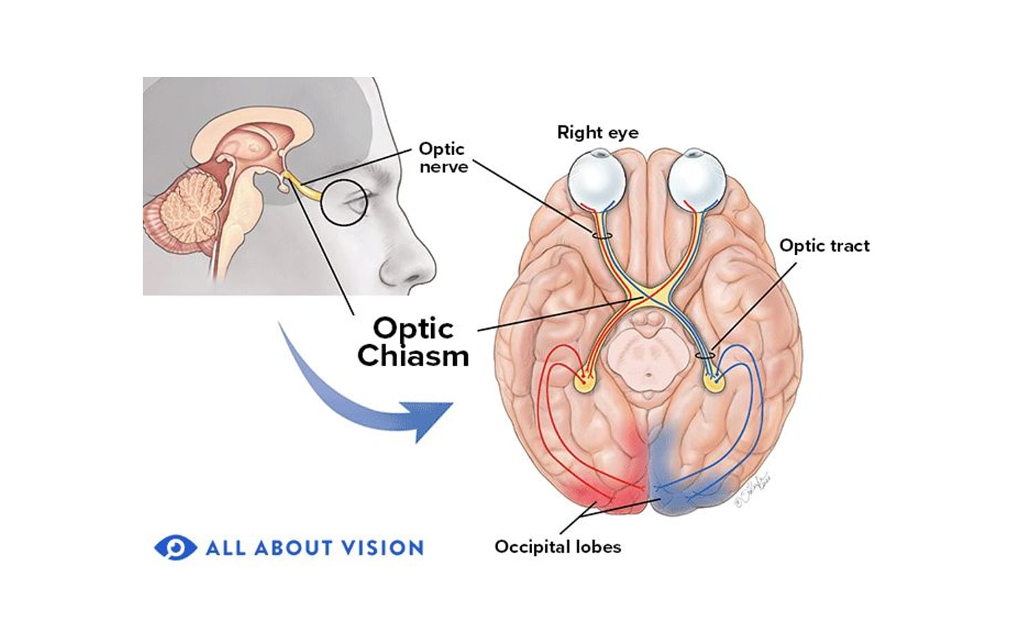 medical illustration of the optic chiasm in the brain
