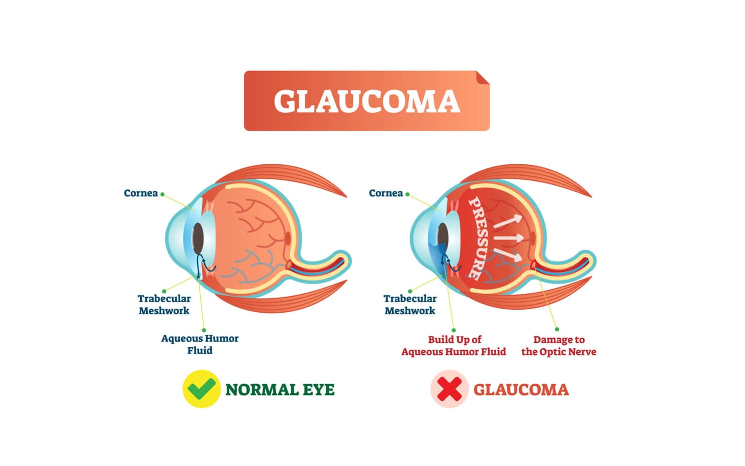 Trabecular Meshwork depiction in a healthy eye v an eye with glaucoma. Trabecular Meshwork depiction in a healthy eye v an eye with glaucoma.