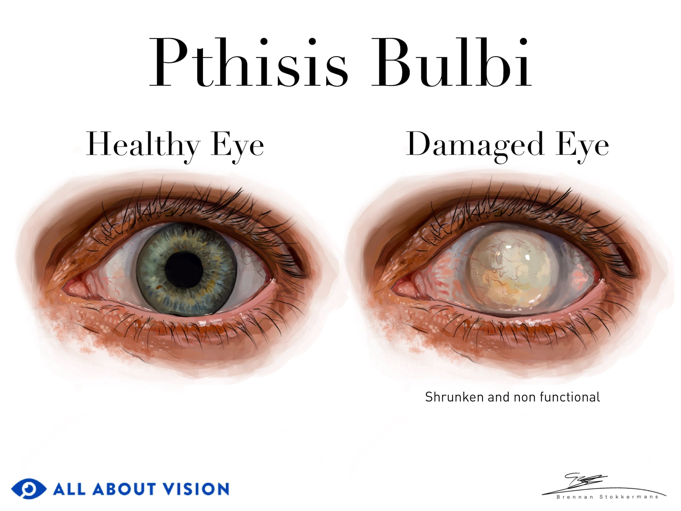 Phthisis bulbi occurs when damage to the eye causes it to completely stop working.