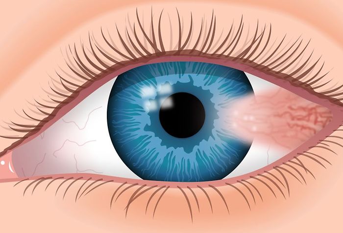 Pterygium: What Is "Surfer's Eye"?