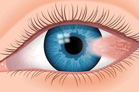 Pterygium illustration