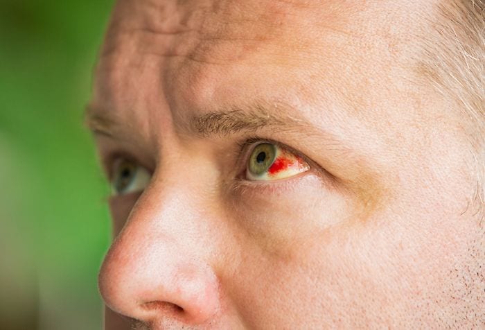 Subconjunctival Hemorrhage (Blood in Eye) - Causes & Treatment