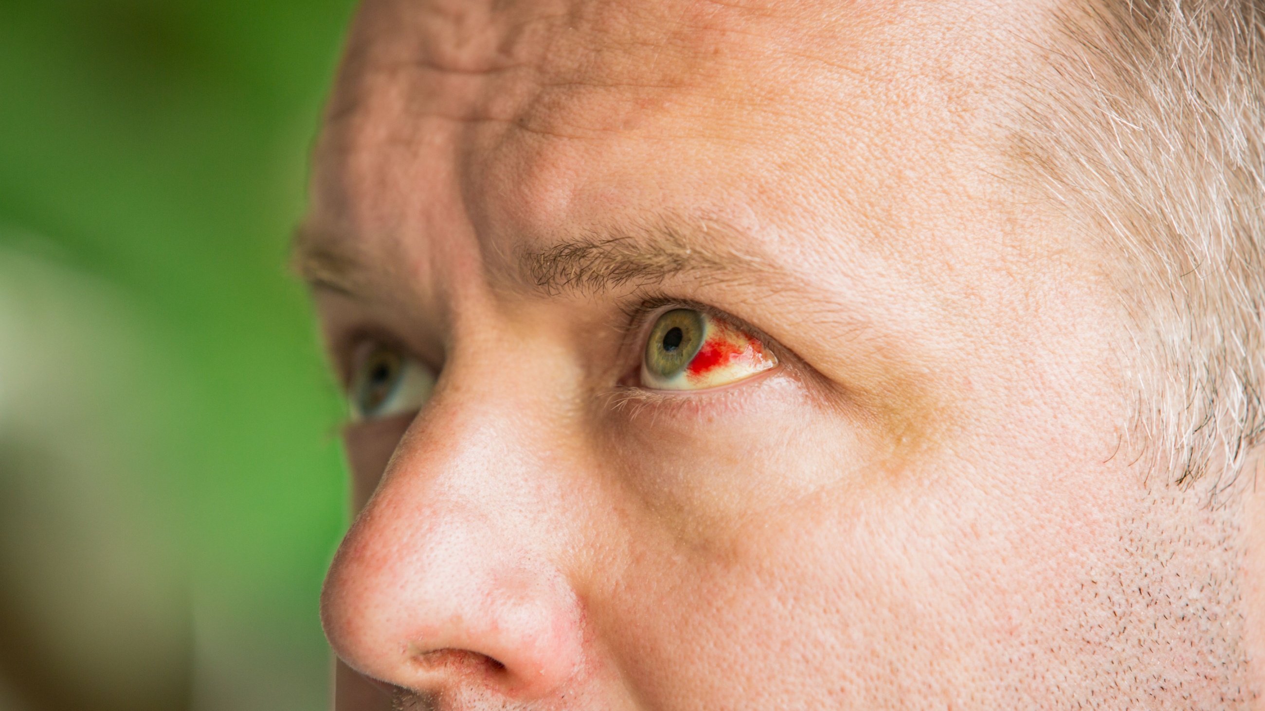 man with a subconjunctival hemorrhage