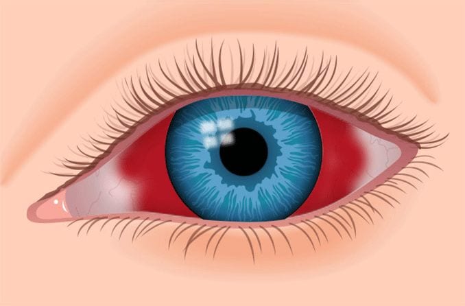 illustration of a subconjunctival hemorrhage illustration of a subconjunctival hemorrhage
