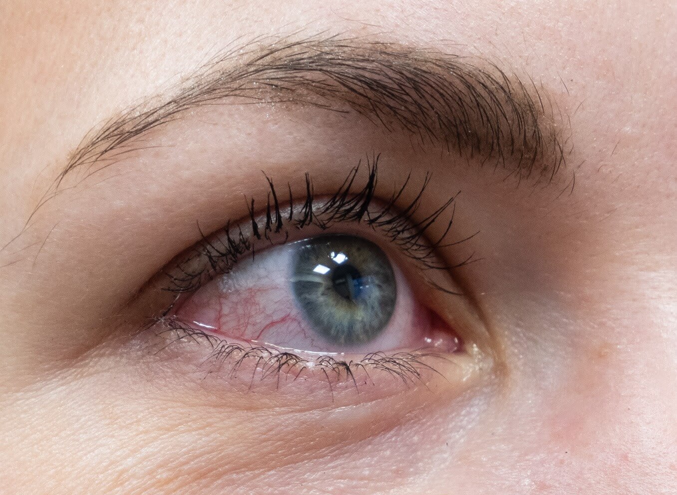 Pink eye irritation from chlorine Pink eye irritation from chlorine