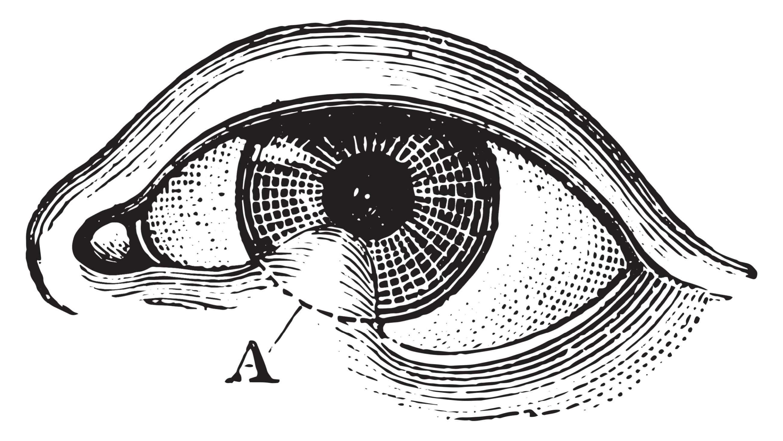 Medical illustration of symblepharons of the eye