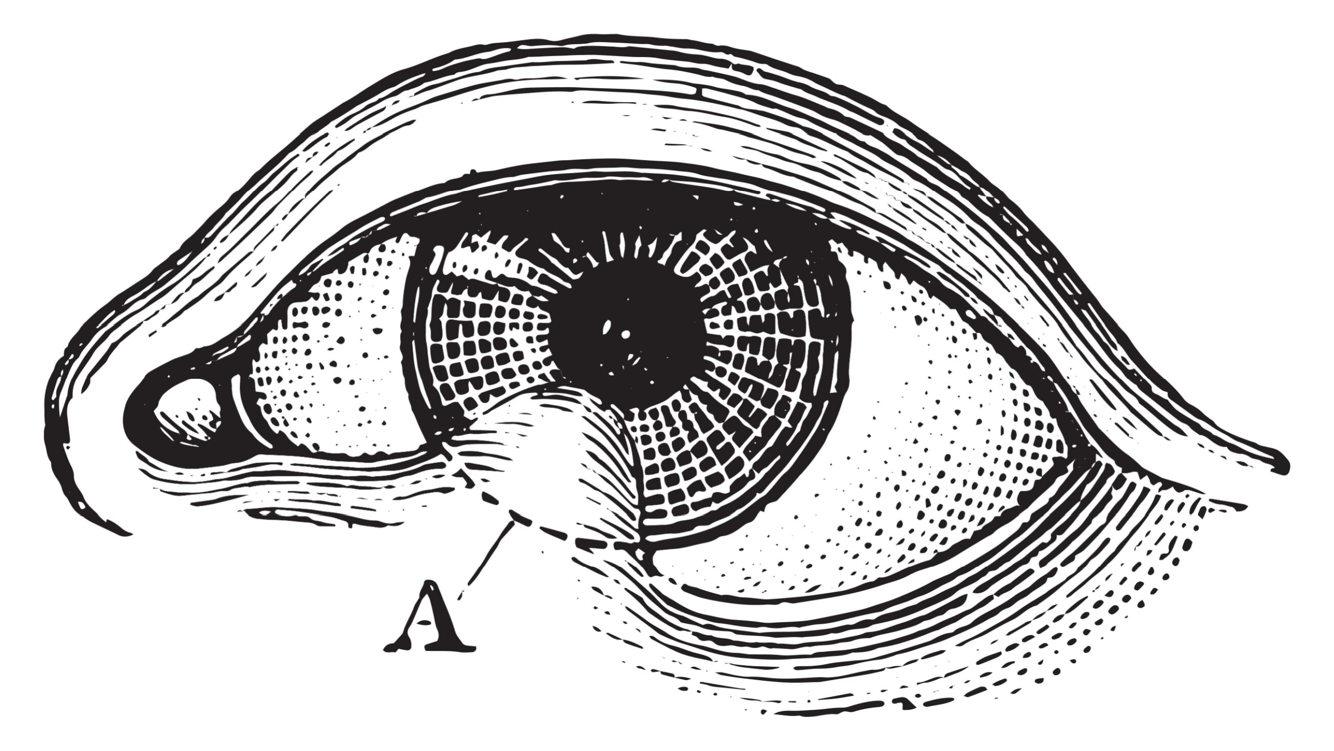 Medical illustration of symblepharons of the eye