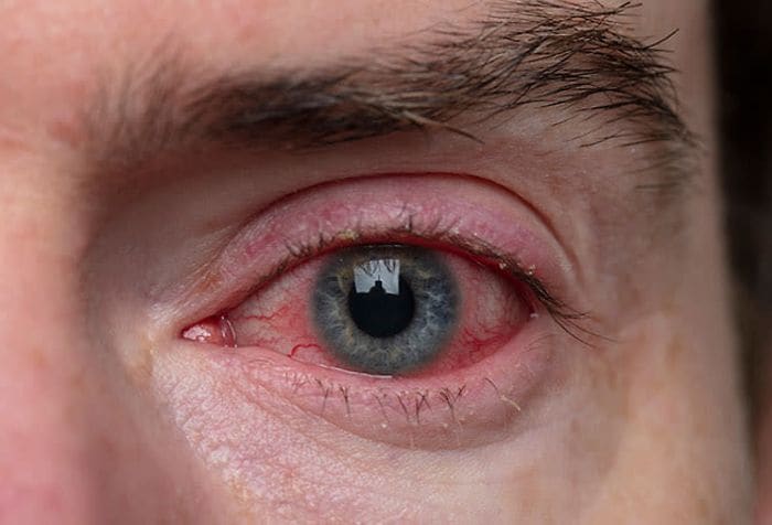 What is blepharitis?