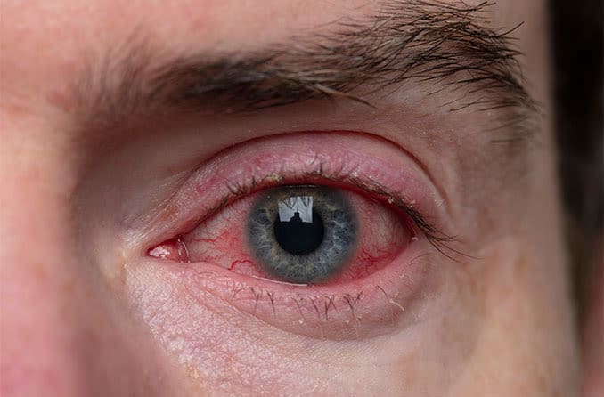 man with swollen eyelid / blepharitis man with swollen eyelid / blepharitis