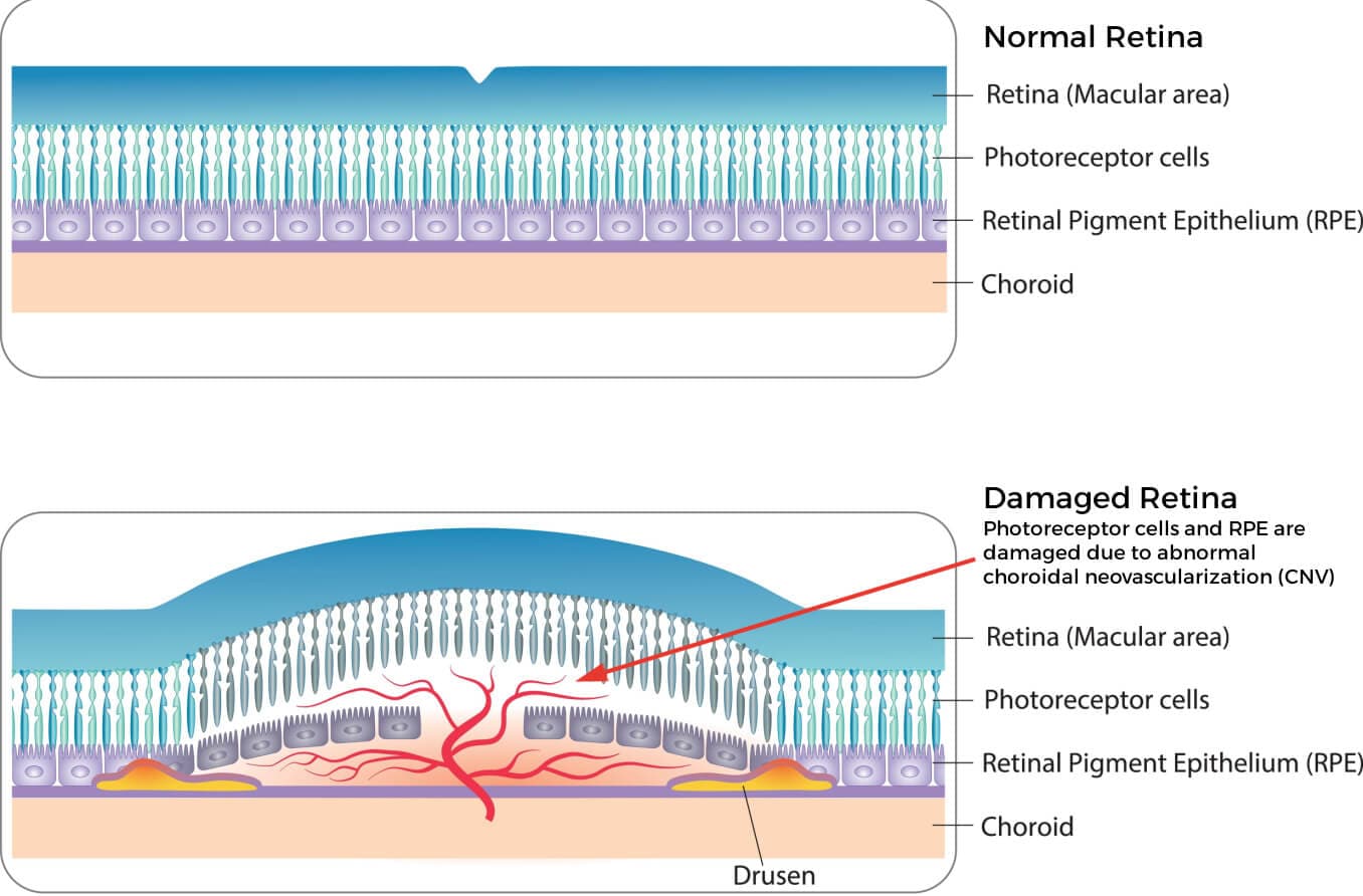 Choroidal neovascularization (CNV): Symptoms and treatments Choroidal neovascularization (CNV): Symptoms and treatments