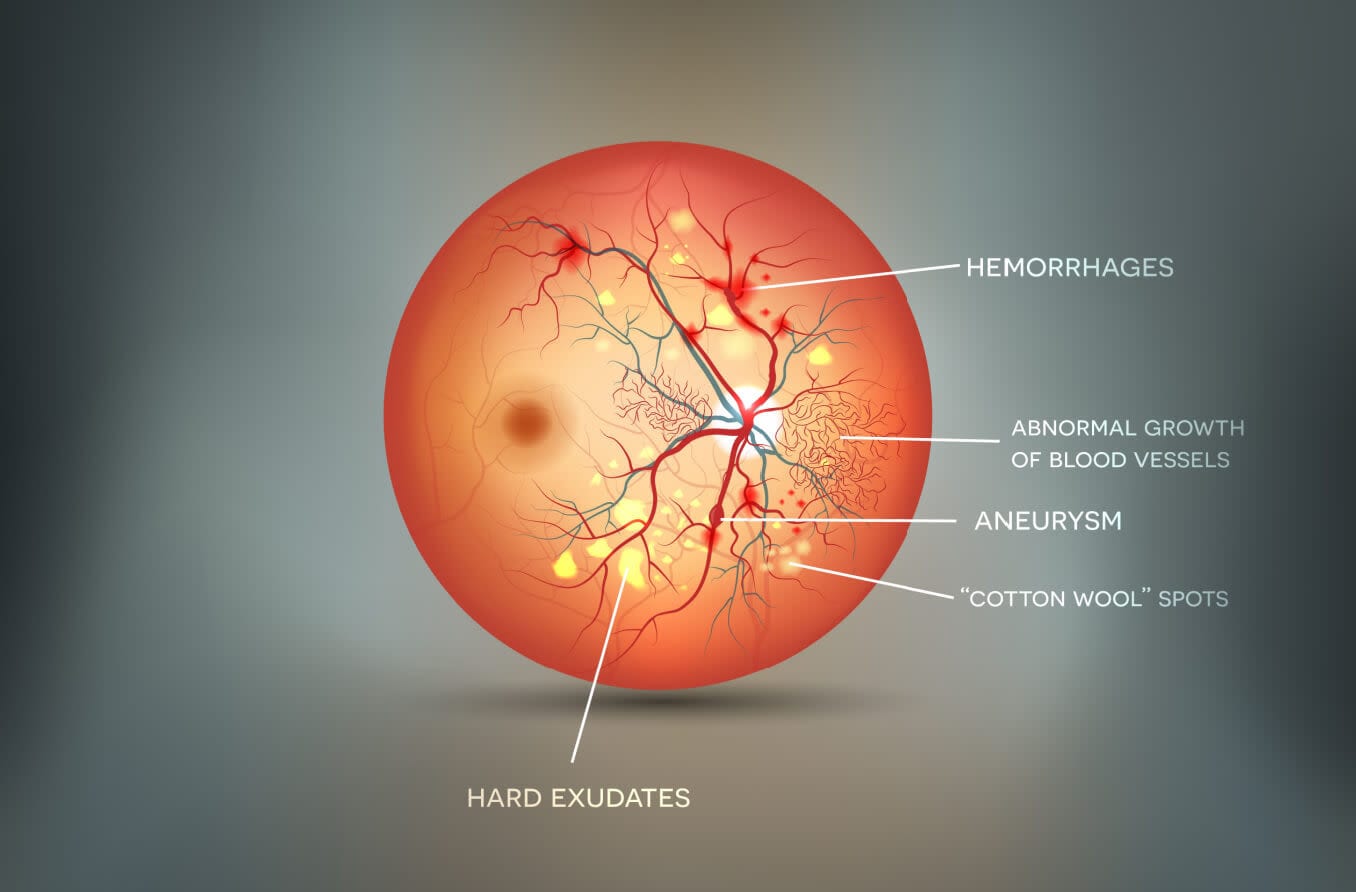 Diagram of a retina and cotton wool spots
