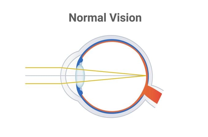 illustration of emmetropia illustration of emmetropia