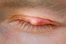 What’s the difference between an eye cyst and an eyelid cyst? What’s the difference between an eye cyst and an eyelid cyst?