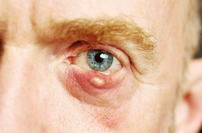 man with an eyelid cyst man with an eyelid cyst