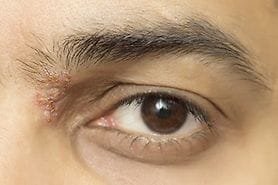 Closeup of a man with eye shingles