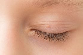 older man getting prepped for eyelid papilloma removal surgery