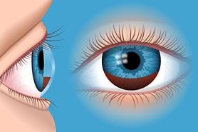 Hyphema: Symptoms, Causes, Treatment & Prevention Hyphema: Symptoms, Causes, Treatment & Prevention