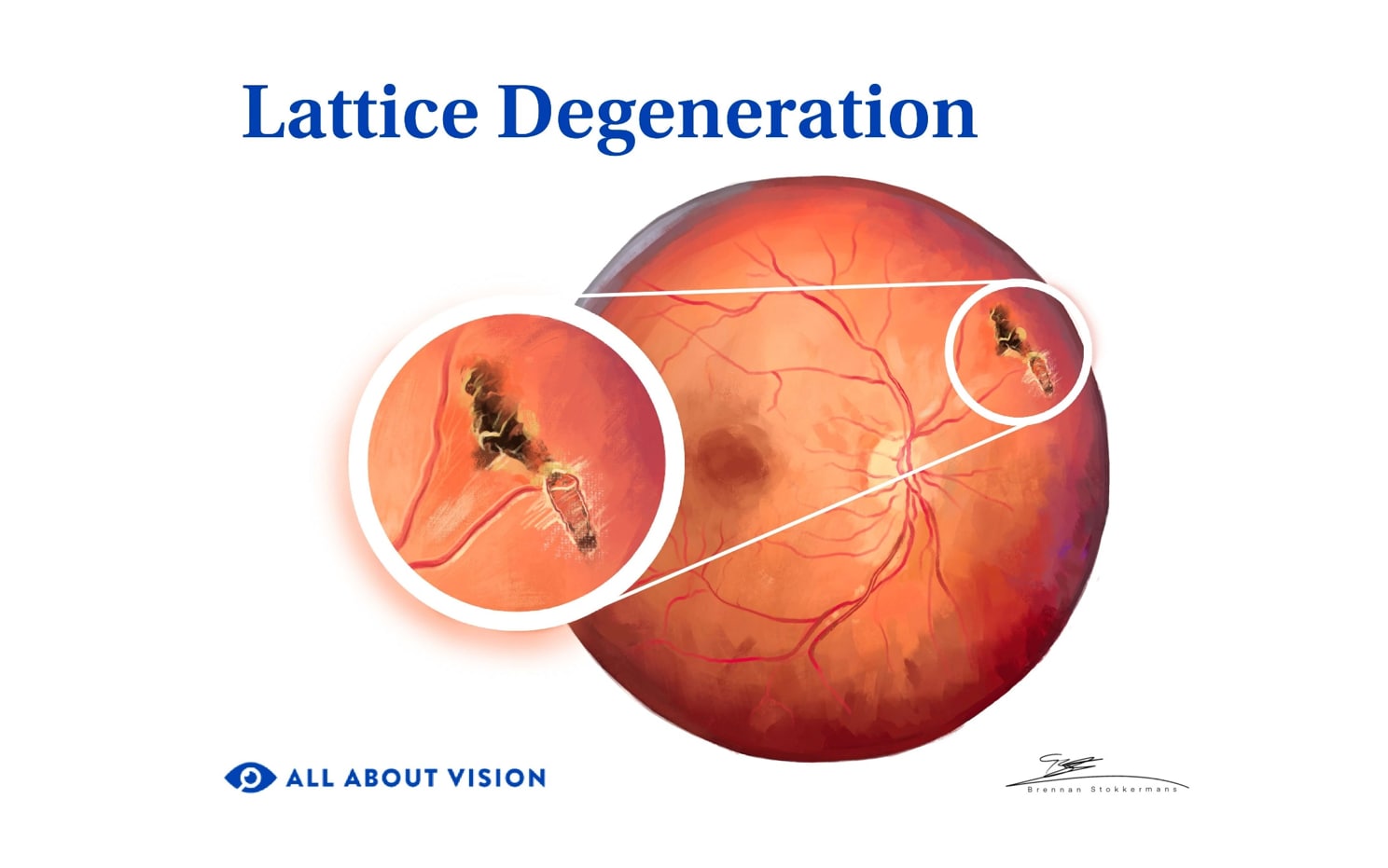 Medical illustration of lattice degeneration of the eye.