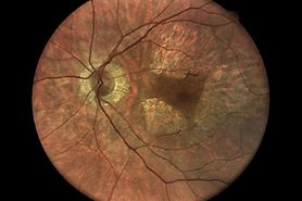 Congenital macular dystrophy on the left eye