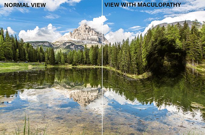side by side mountain view of normal vision vs vision with maculopathy side by side mountain view of normal vision vs vision with maculopathy