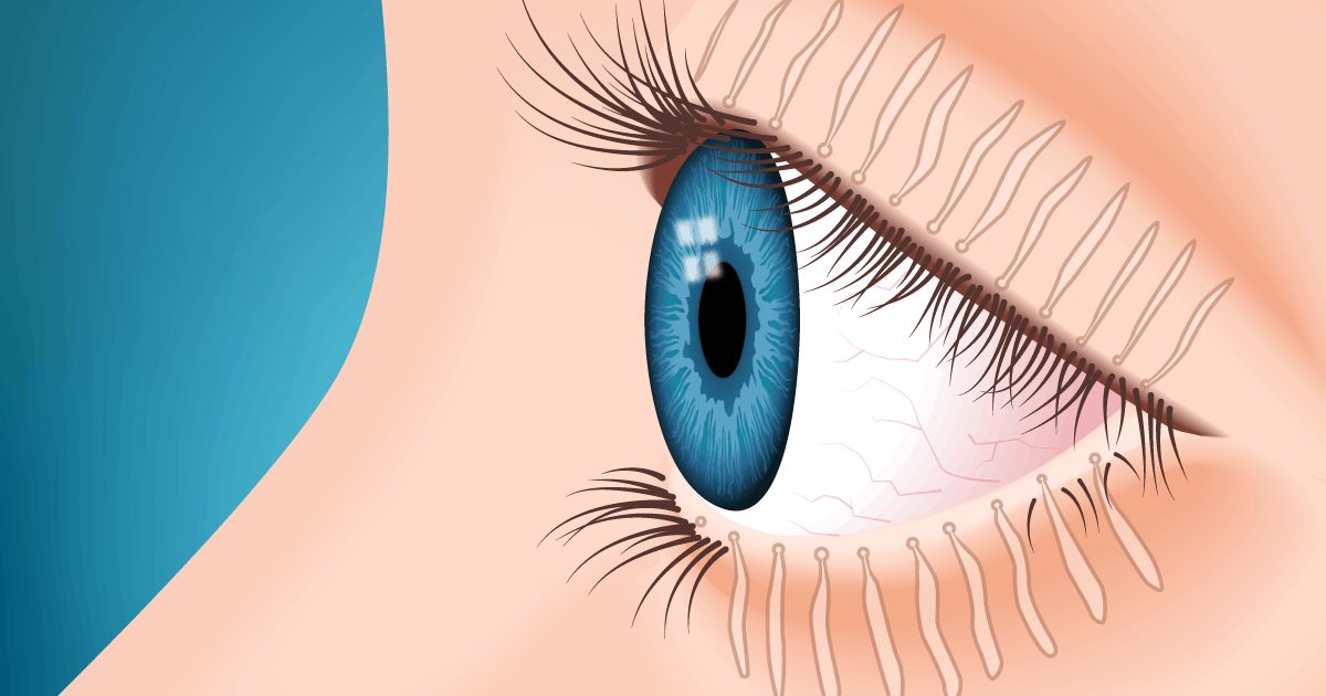 Illustration of eye with meibomian glands Illustration of eye with meibomian glands