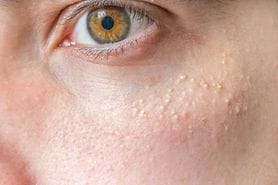 closeup of milia bumps on cheek below the eye